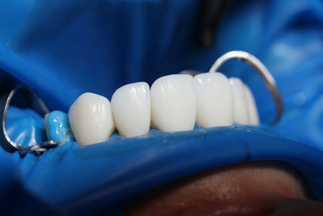 Veneers vs Crowns vs Implants: Which is Best?